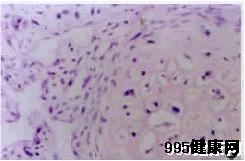 鳞状细胞相关抗原(SCC)的介绍