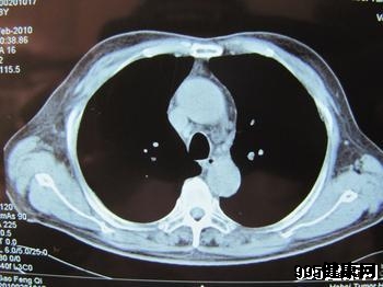 肺鳞癌晚期治疗