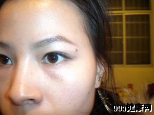 汗管瘤要怎么诊断