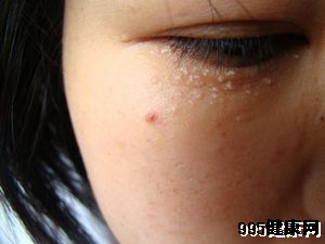 汗管瘤的发病因素有哪些
