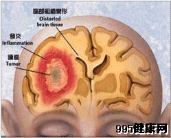 大脑凸面脑膜瘤的临场症状及并发症状