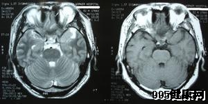 矢状窦旁脑膜瘤的临床诊断