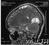 典型脑膜瘤的症状表现有哪些?