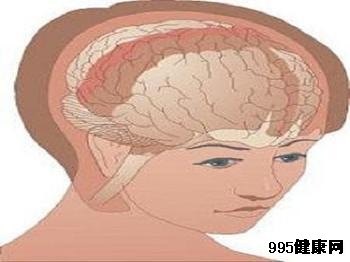 大脑凸面脑膜瘤症状