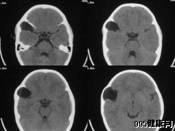 岩骨斜坡脑膜瘤的发病机制