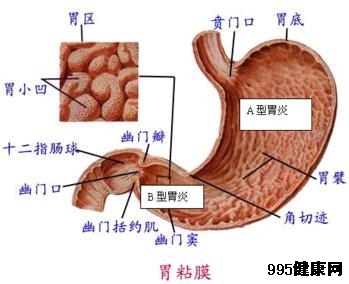 导致胃泌素瘤发生的原因