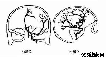 多发性脑膜瘤的介绍