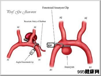 动脉瘤的并发症有哪些?