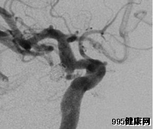 颅内动脉瘤的常见症状