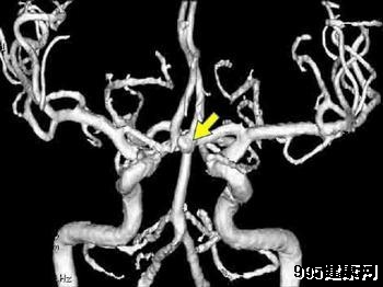 动脉瘤出现的位置及原因