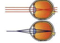 近视眼概述