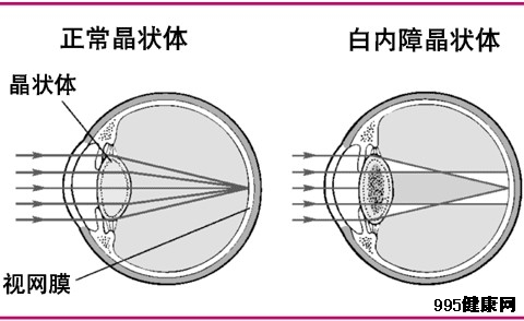 得了白内障怎么办?