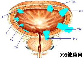 膀胱肿瘤的临床表现