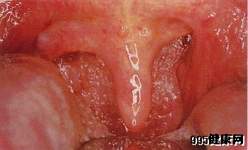 什么是喉癣?
