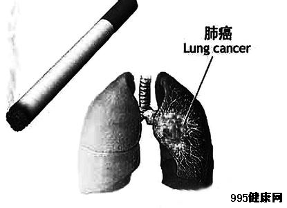 肺癌的四种放疗方法