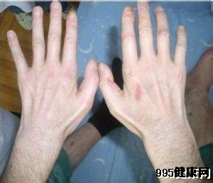 腱鞘炎的常见临床症状有哪些?