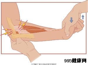 早期网球肘的病症有哪些?