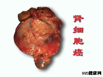 新抗癌药物可延长肺癌和肾癌患者生存期