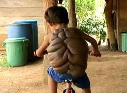 哥伦比亚8岁“海龟男孩”脱去“龟壳”