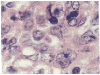 指突状网状细胞肉瘤一例