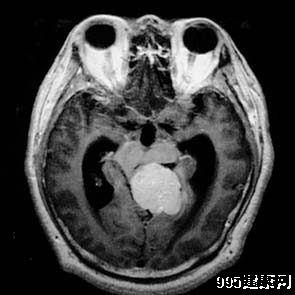 专家浅析多发性脑膜瘤
