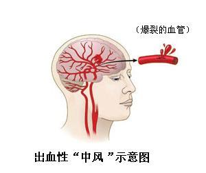 出血性脑中风的发病的原因是什么