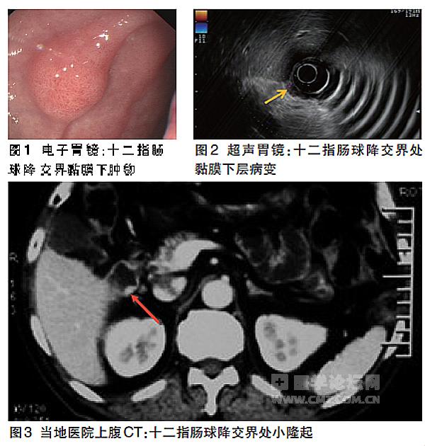 病例分析胃泌素瘤的诊治