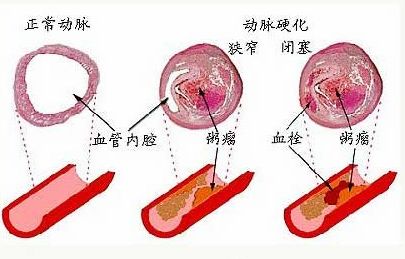 警惕动脉硬化的早期危险信号