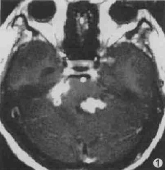 1.5T MR诊断脑结核瘤