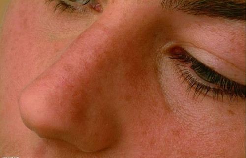 常见的慢性鼻炎的症状有哪些