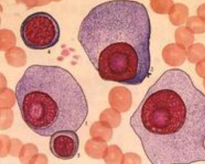 多发性骨髓瘤的免疫学分型是怎样的？