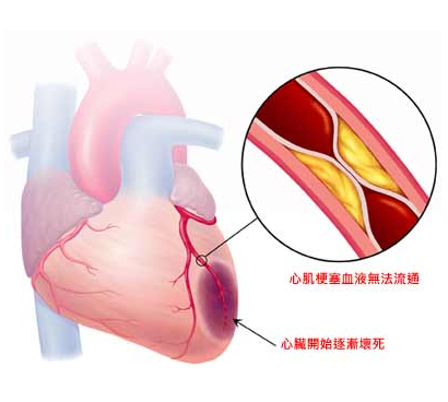 六种无典型症状的心肌梗塞要警惕