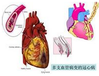 注意：引发冠心病的4大因素