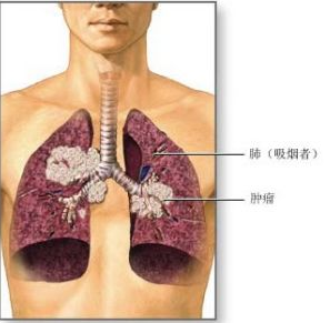 注意：诊断肺癌的三种方法