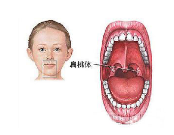 扁桃体切除术的副作用有哪些？